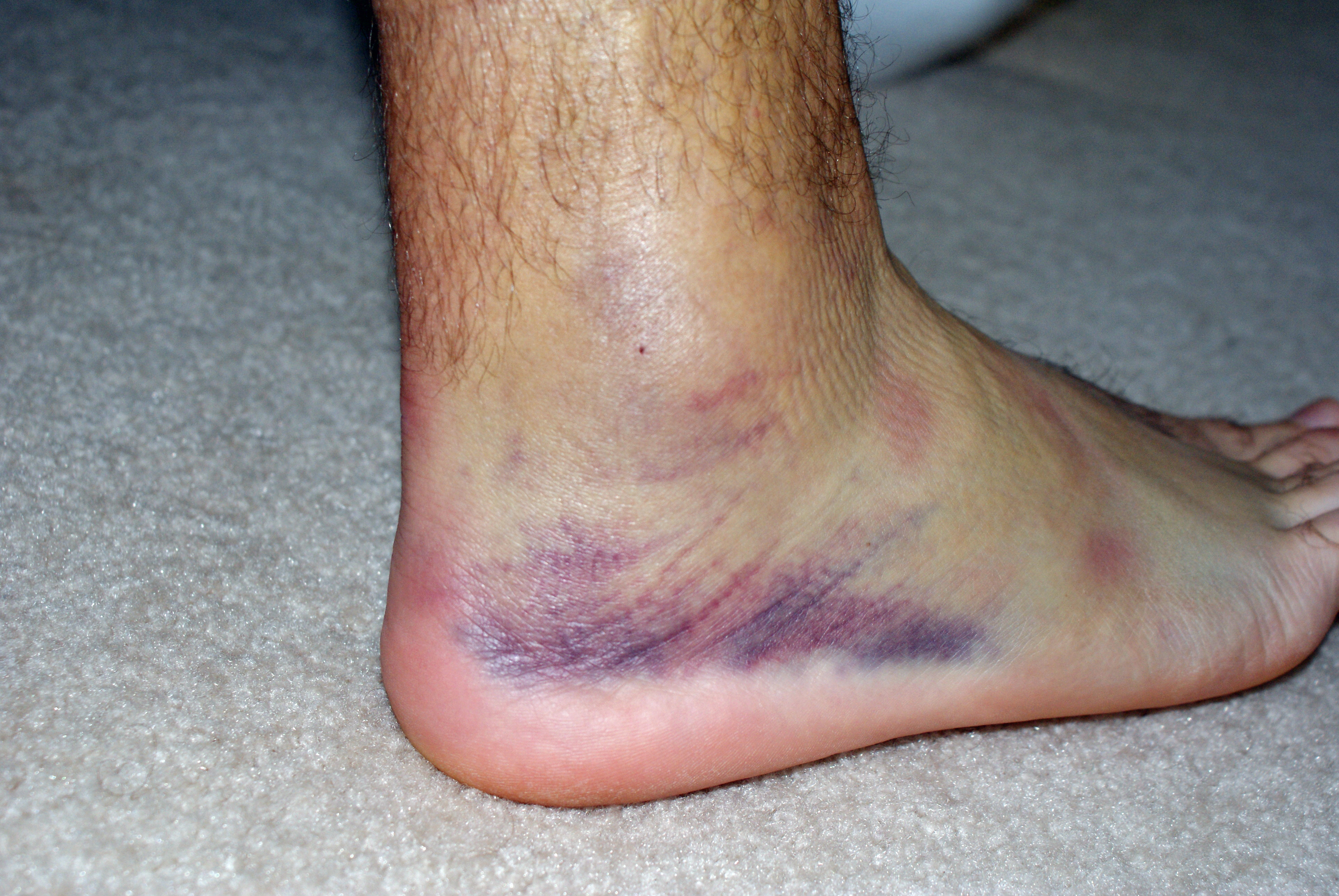 Can Swollen Legs & Feet Leave Feet Bruised 102